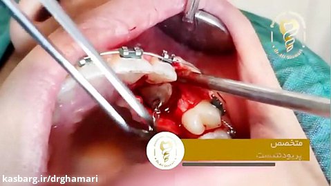 فیلم واقعی جراحی اکسپوژر دندان
