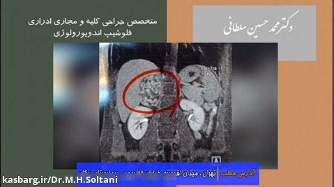 انجام لاپاروسكوپی در توده های بزرگ - دکتر محمد حسین سلطانی