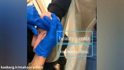 فیلم واقعی درمان تعریق کف دست با تزریق بوتاکس