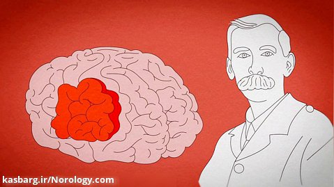 در هنگام تشنج در مغز شما چه اتفاقی می افتد؟