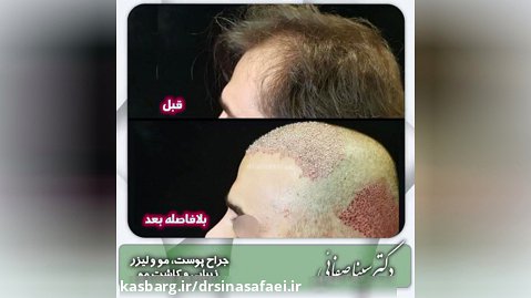 کاشت مو توسط دکتر صفائی