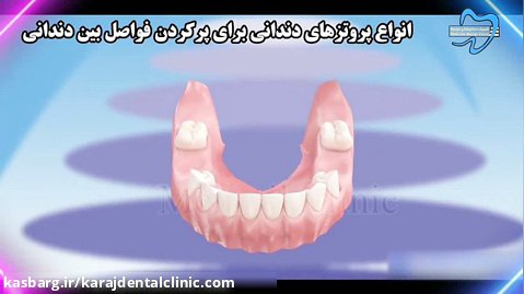 انواع پروتز های دندانی برای پر کردن فواصل بین دندان ها